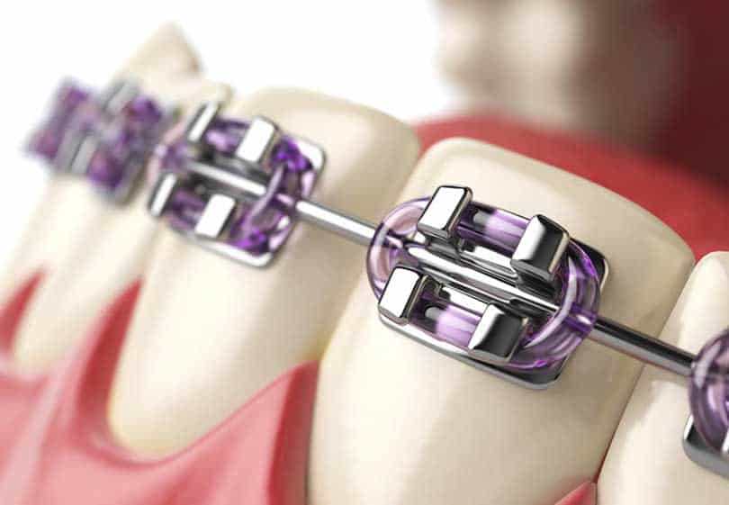 Braces and Orthodontics