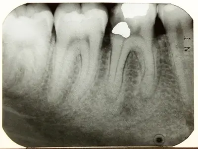 Dental X-Ray